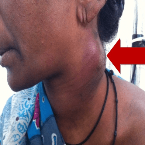 Close-up of a woman's neck showing a bruise and swelling highlighted by an arrow.