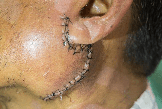 Neck Swelling Explained by an ENT Specialist in Kuala Lumpur – Part&nbsp;6