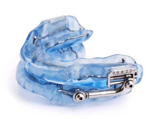 A blue dental mouthguard with adjustable metal components, designed for sleep apnoea treatment.