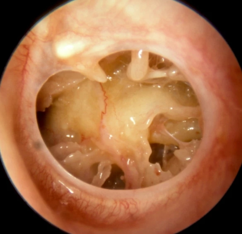 Adakah Kita Masih Boleh Mendengar Jika Gegendang Telinga Pecah&nbsp;Sepenuhnya?