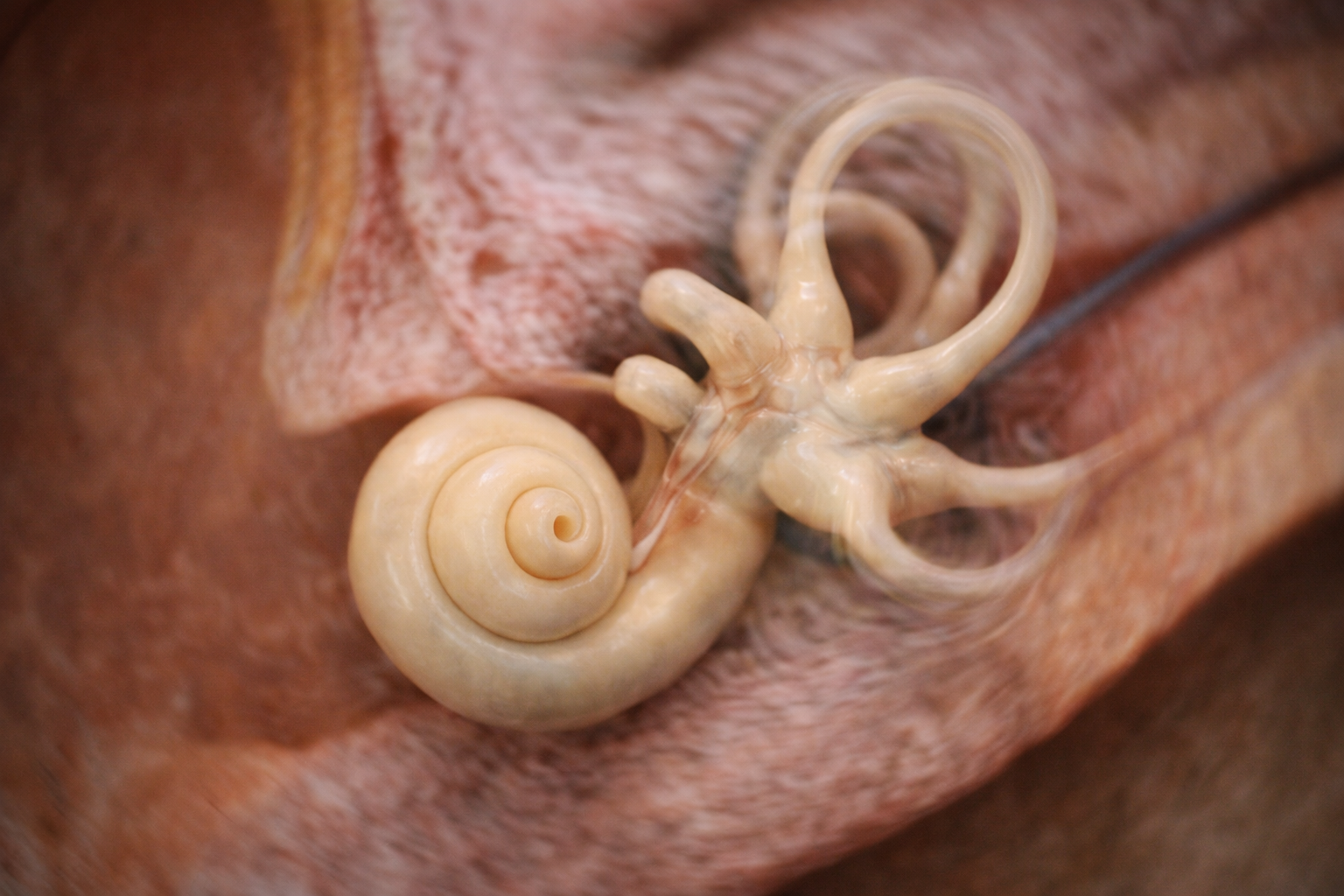Understanding 9 Uncommon Causes of Chronic Vertigo – A Clinician’s Guide