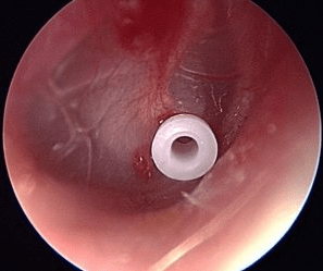 Close-up view of a tubular structure with a white round object inside, appearing to be from a medical endoscopic examination.