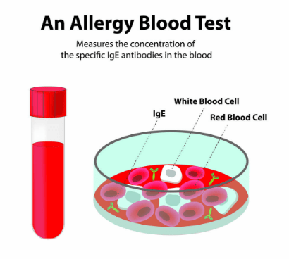 An illustration of an allergy blood test showing a test tube filled with blood and a petri dish displaying red and white blood cells, with IgE antibodies labelled.
