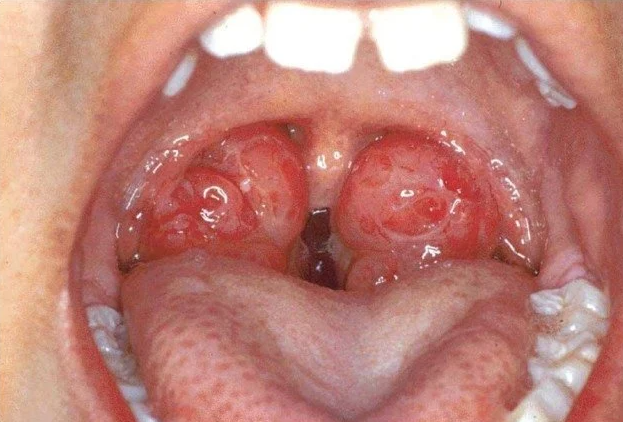 Do you know why children can still breathe through their mouth even with large tonsils?