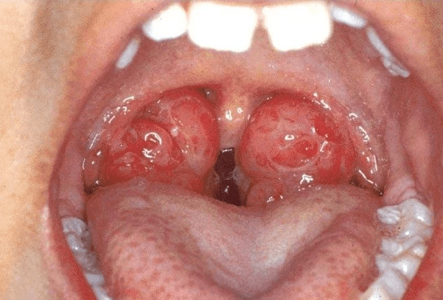 Do you know why children can still breathe through their mouth even with large tonsils?