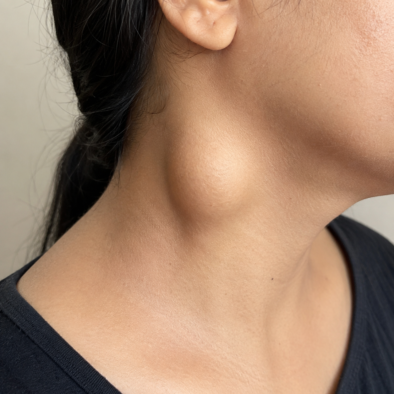 Neck Lumps Logo